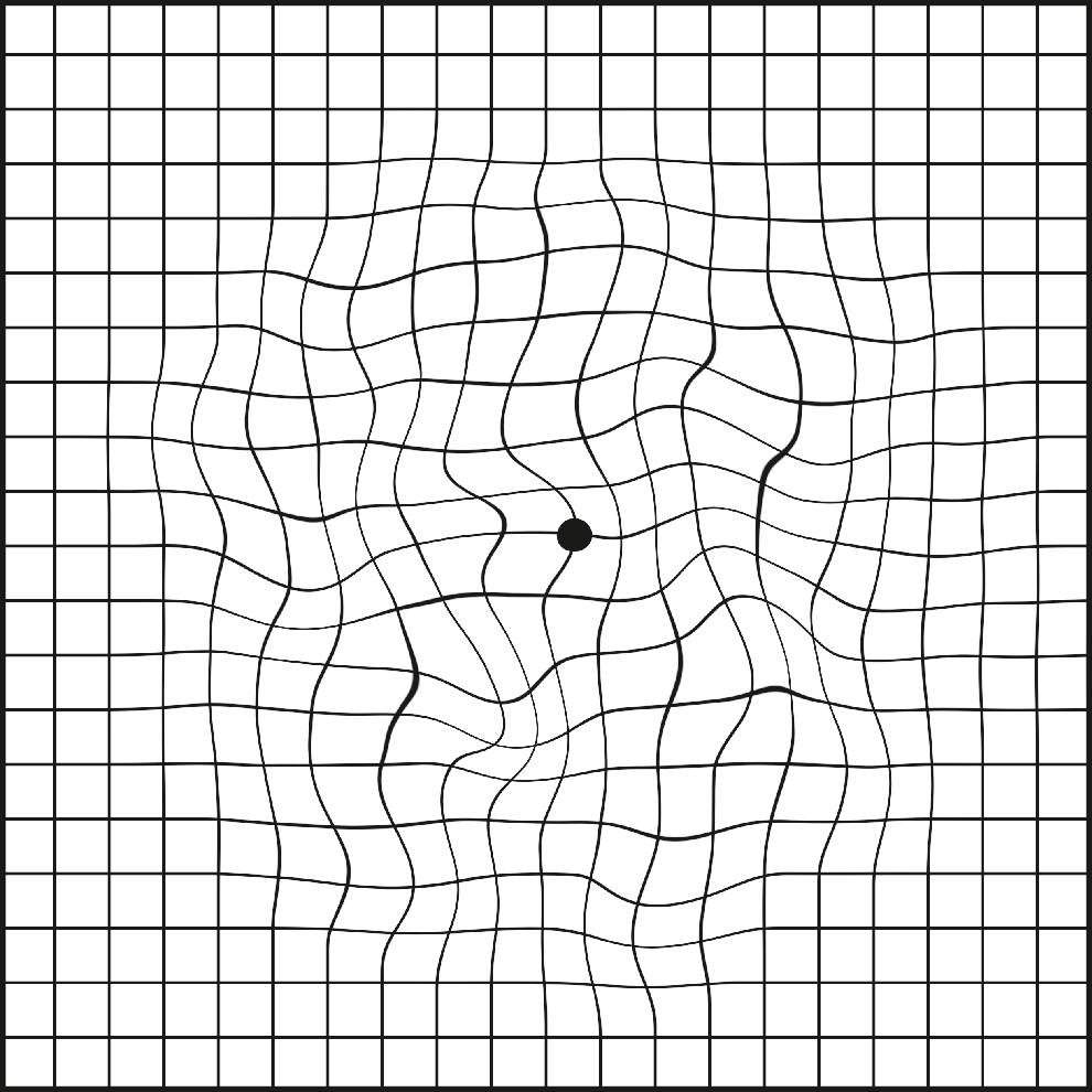 Amsler-Gitter-Test mit verzerrten oder gewellten Linien.